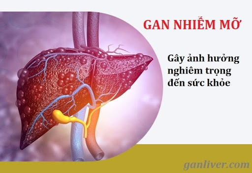 Gan nhiễm mỡ có nguy hiểm không? Giải pháp cải thiện bệnh an toàn, hiệu quả